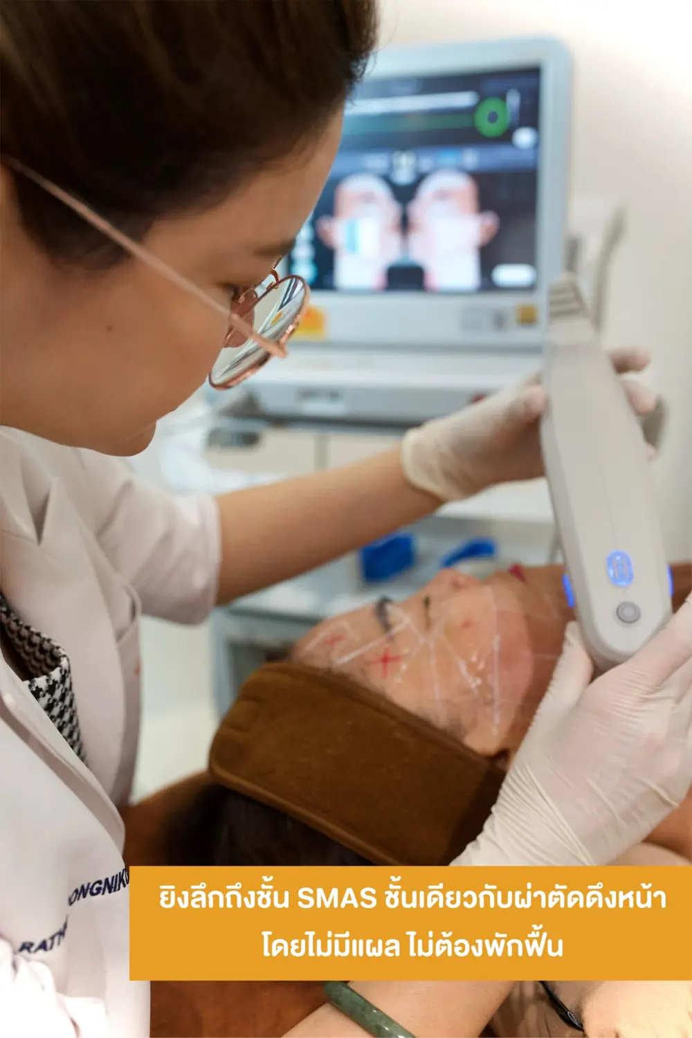 บรรยากาศการทำ Ultherapy Prime ที่ Peace Clinic 2