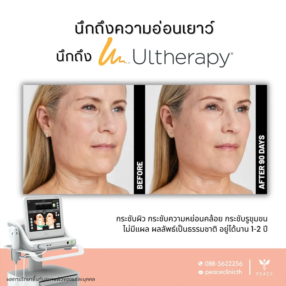 รีวิวผลลัพธ์ Ultherapy Prime ที่ Peace Clinic 1