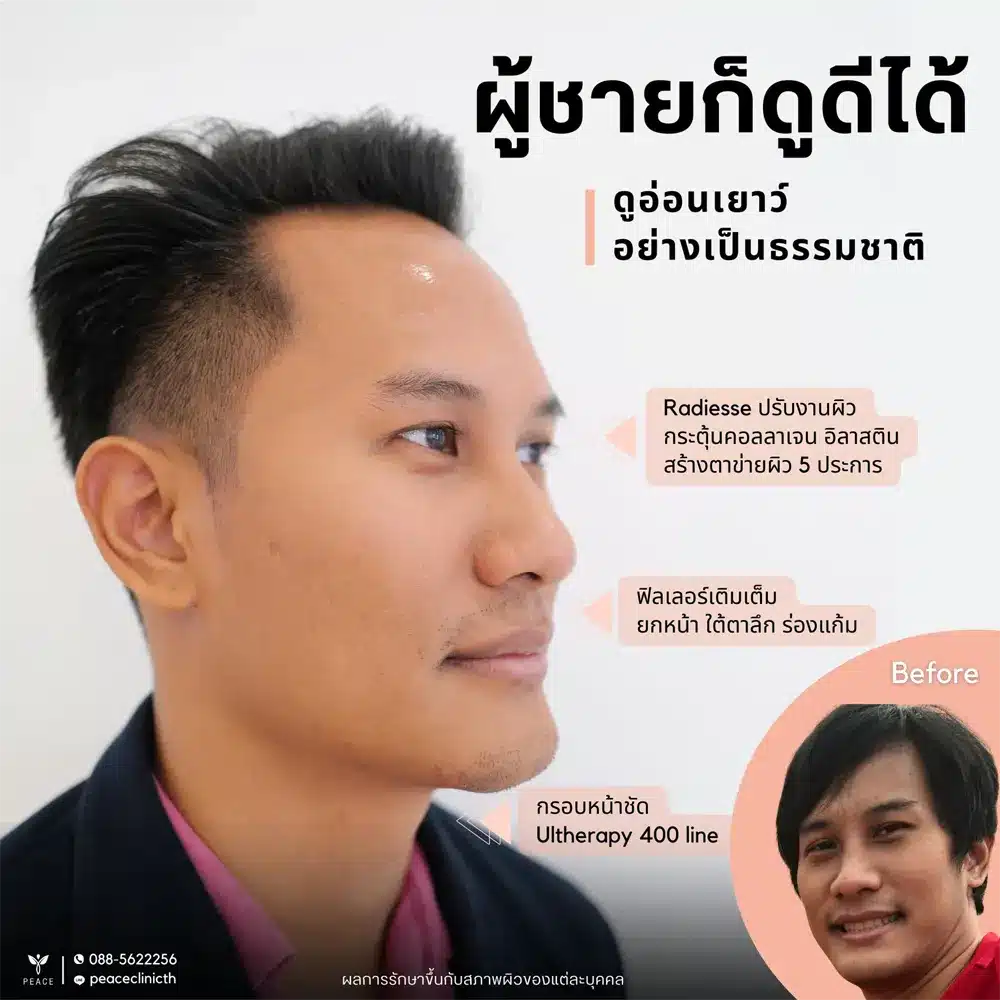 รีวิวผลลัพธ์ Ultherapy Prime ที่ Peace Clinic 2