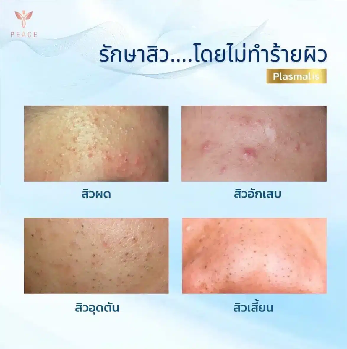 Plasmalis ช่วยเรื่องอะไรบ้าง ?