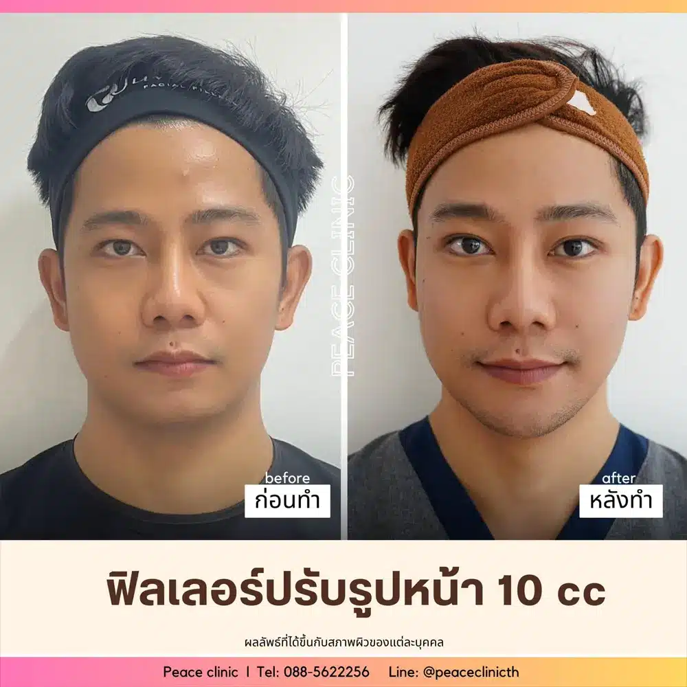 รีวิวผลลัพธ์ Filler Program ที่ Peace Clinic 6