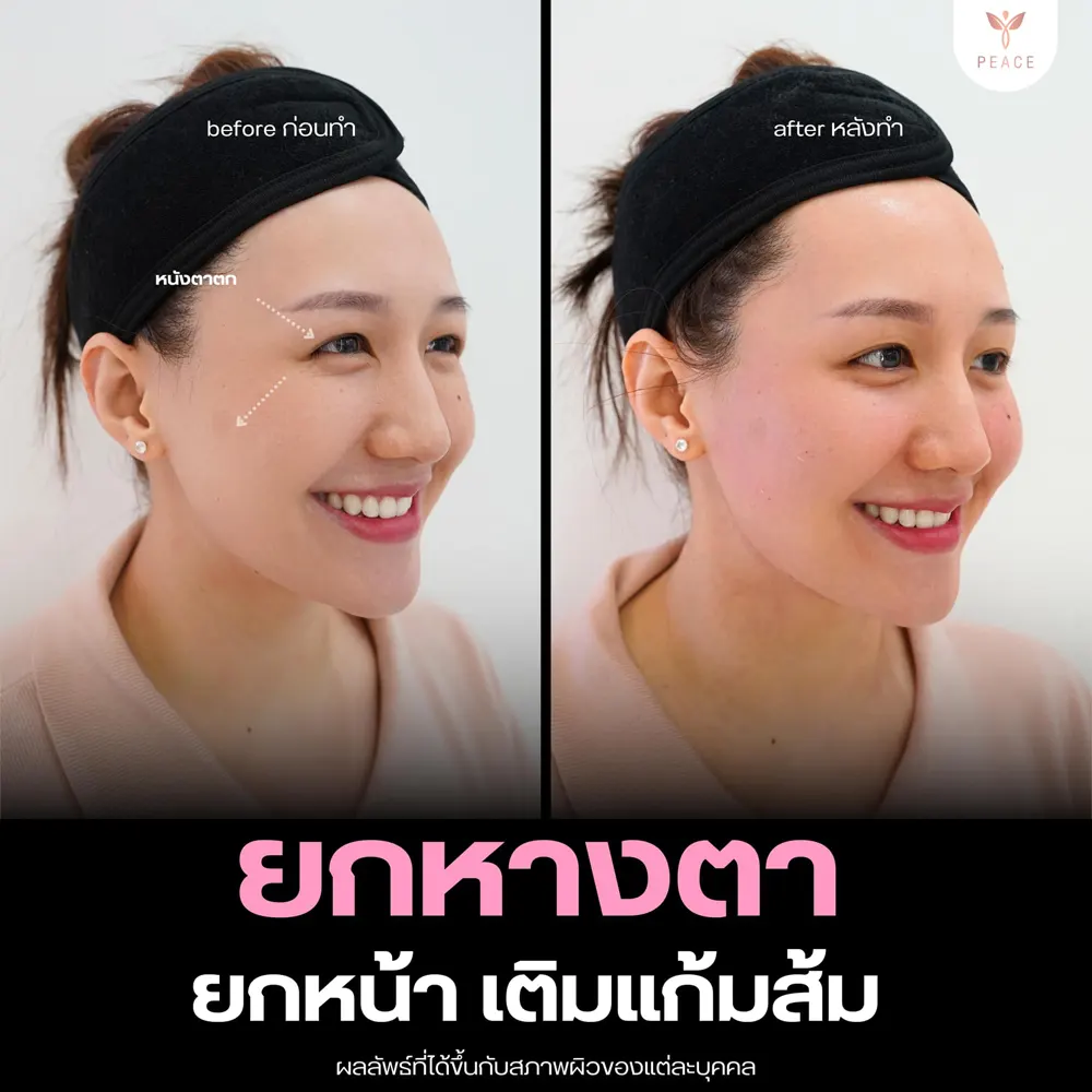 รีวิวผลลัพธ์ Filler Program ที่ Peace Clinic 5