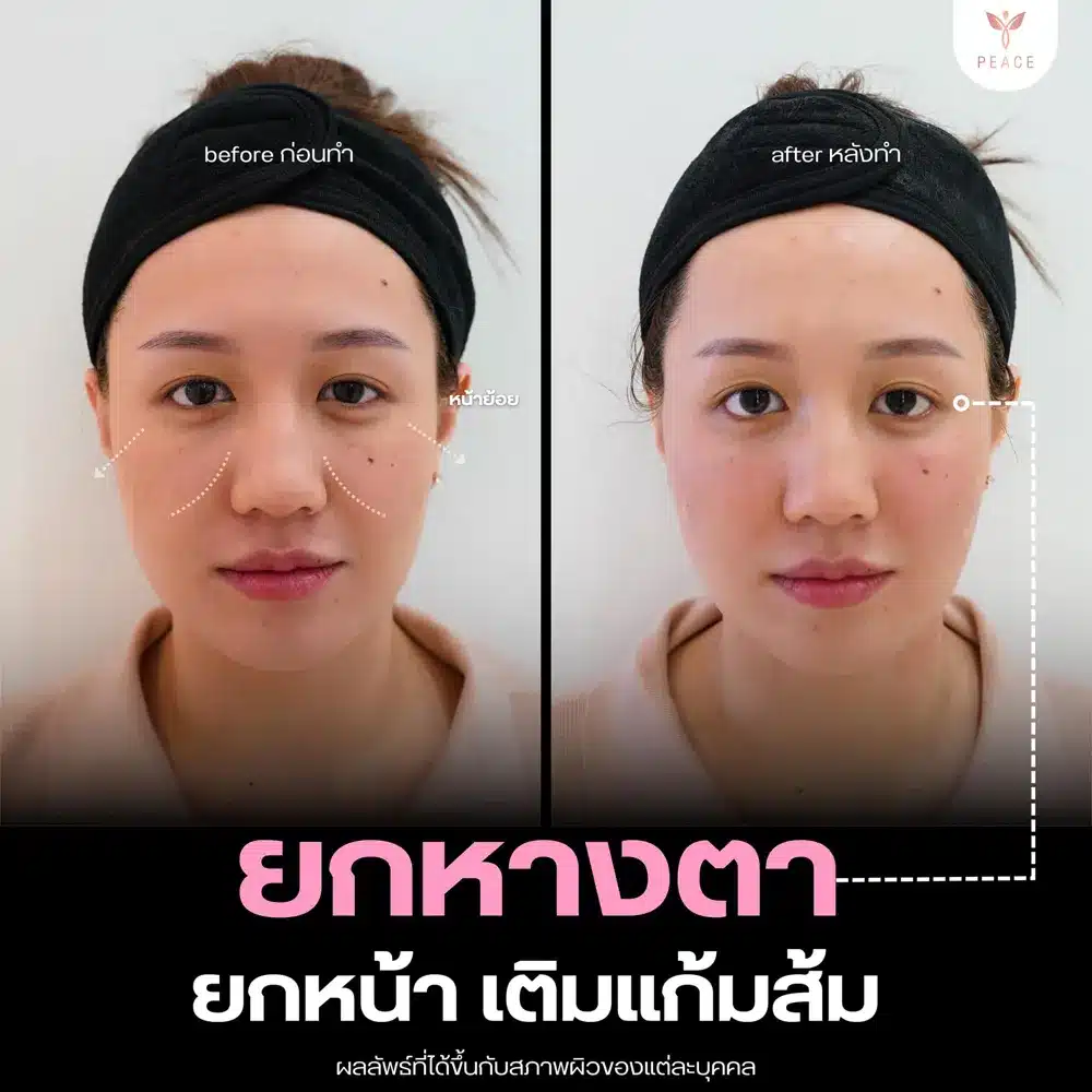 รีวิวผลลัพธ์ Filler Program ที่ Peace Clinic 4