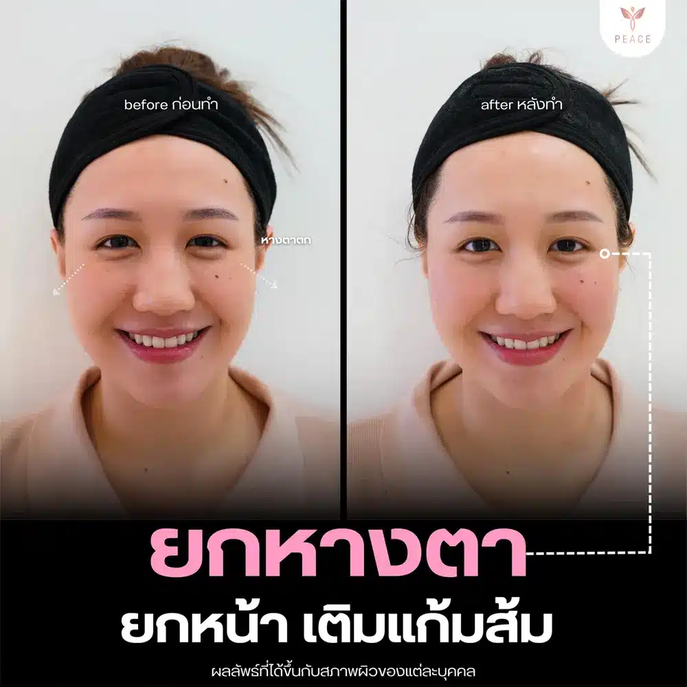 รีวิวผลลัพธ์ Filler Program ที่ Peace Clinic 3