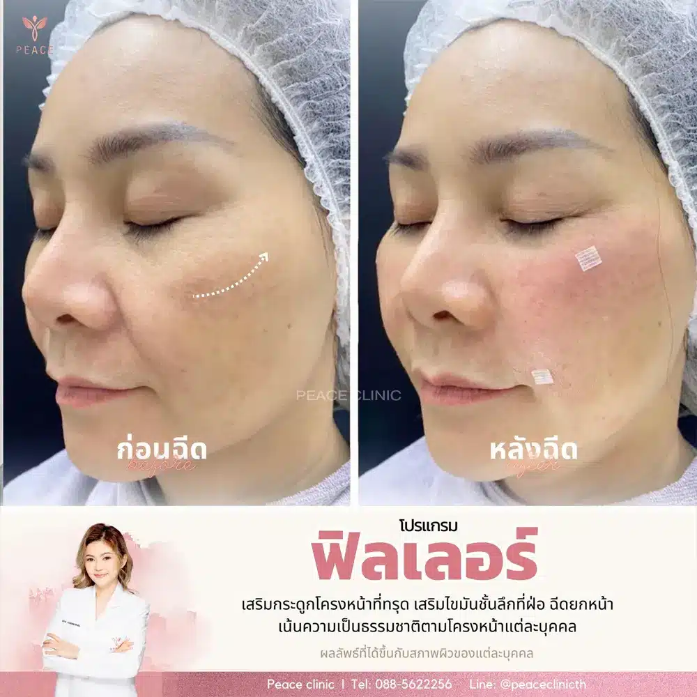 รีวิวผลลัพธ์ Filler Program ที่ Peace Clinic 2