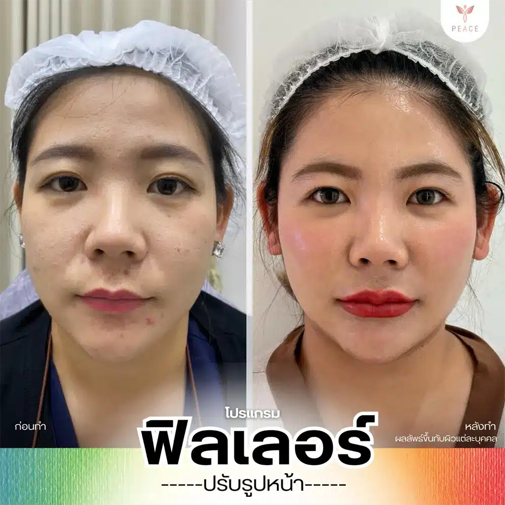 รีวิวผลลัพธ์ Filler Program ที่ Peace Clinic 1