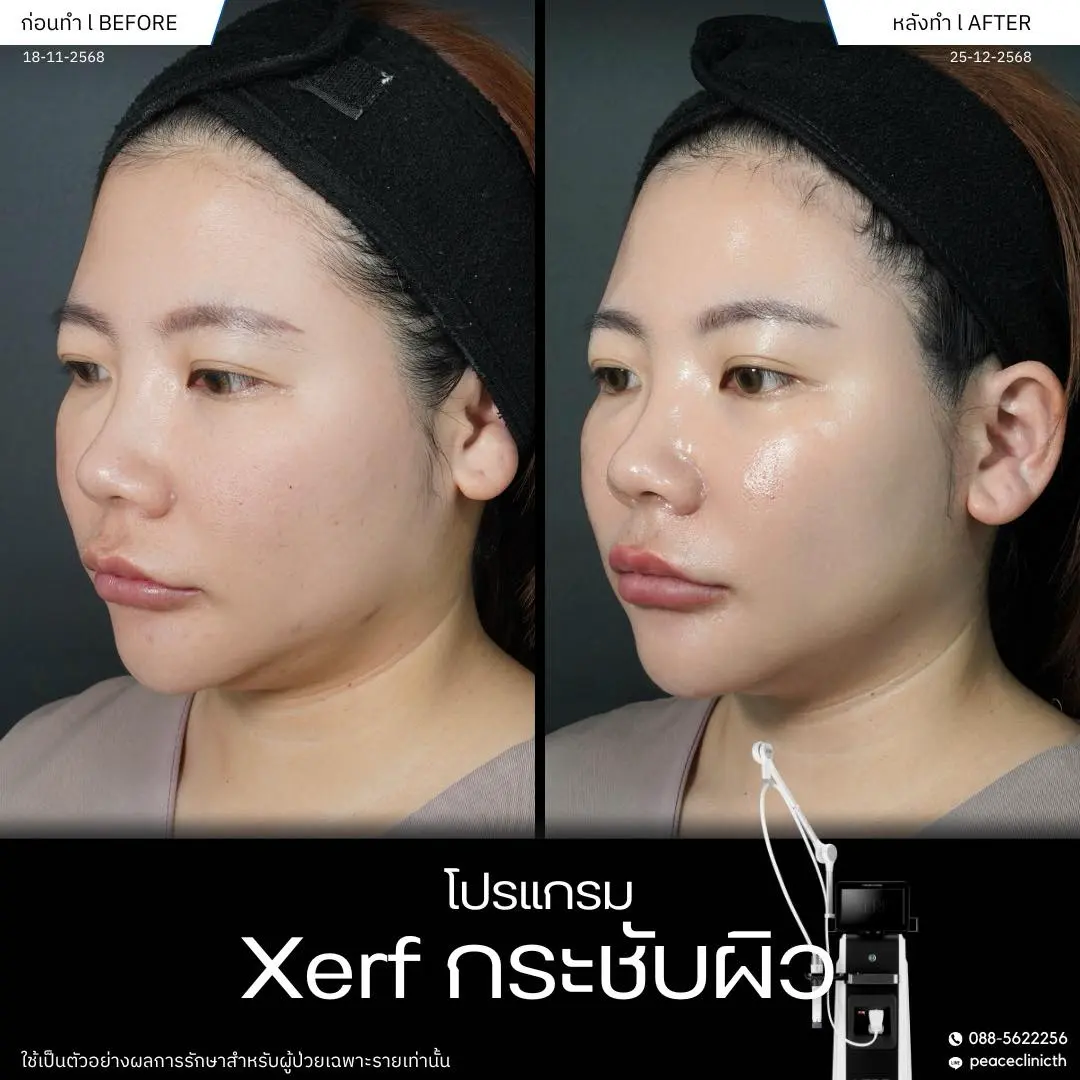 ทำโปรแกรม XERF ที่ Peace Clinic ดีอย่างไร
