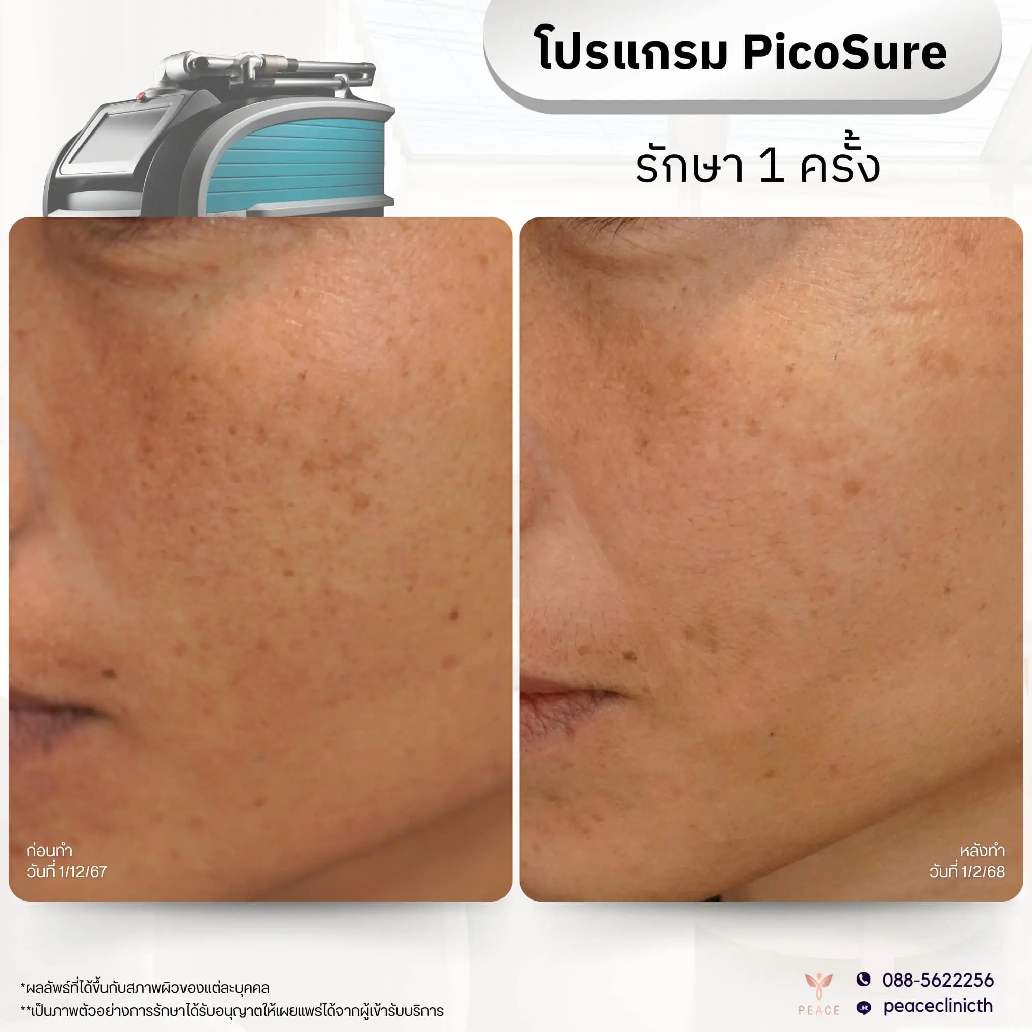 รีวิวผลลัพธ์ โปรแกรม PicoSure แม่สอด 1