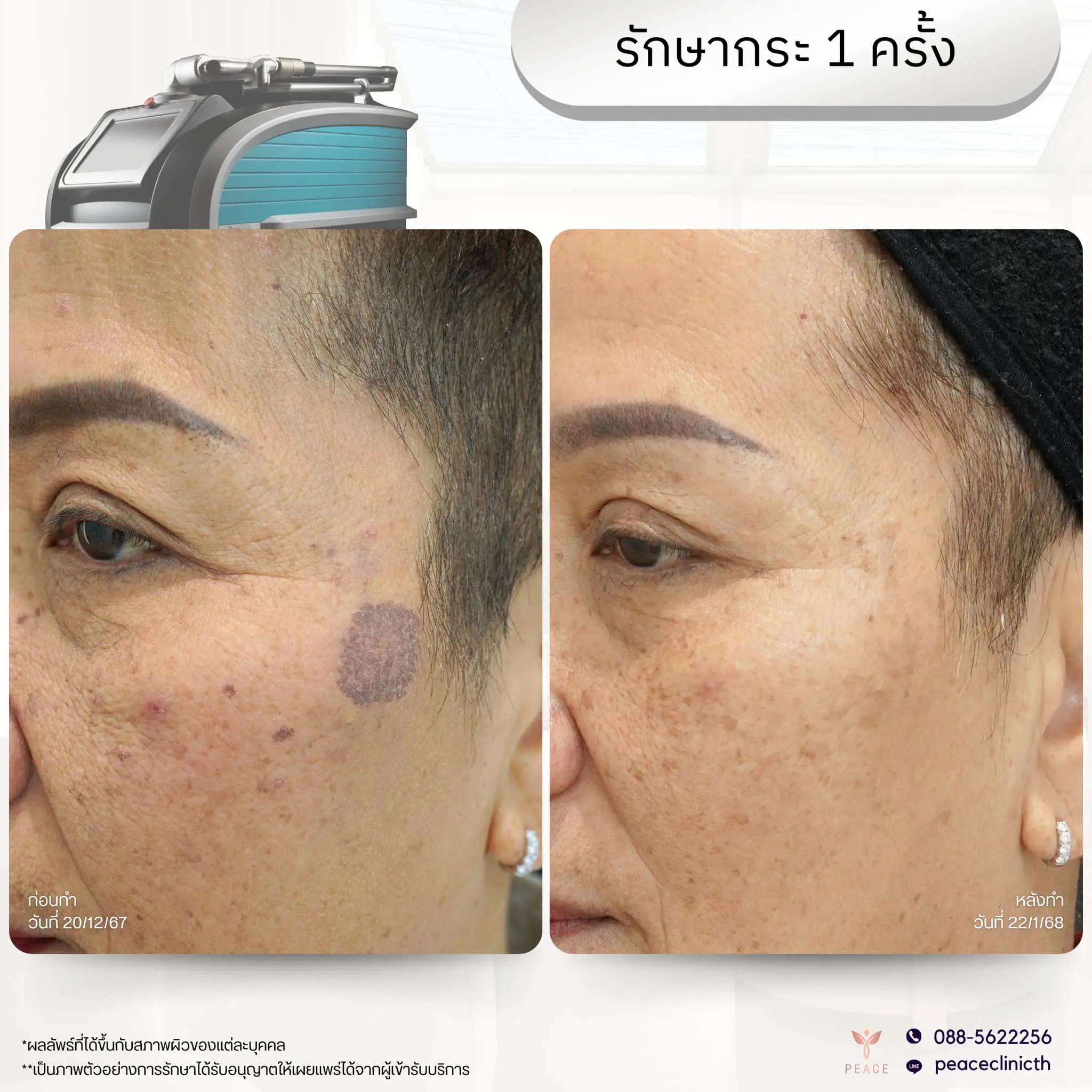 รีวิวผลลัพธ์ โปรแกรม PicoSure แม่สอด 2