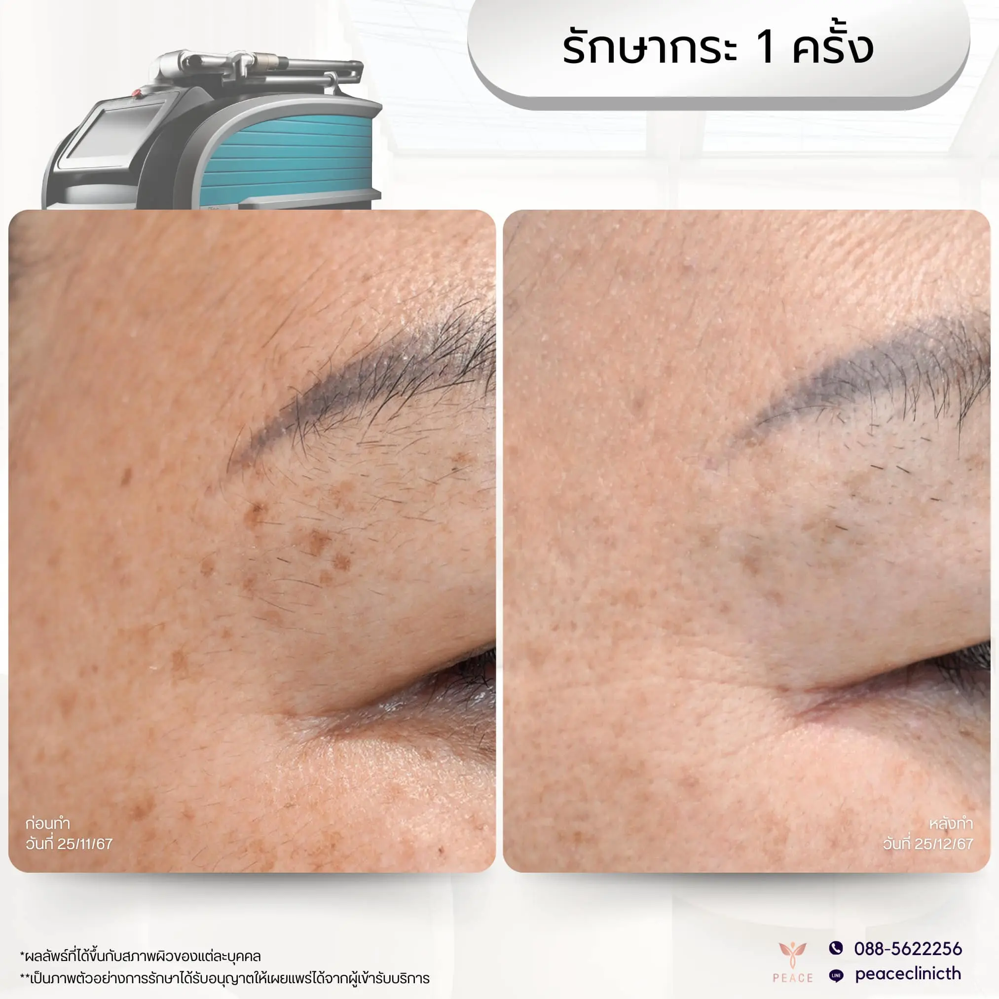 รีวิวผลลัพธ์ โปรแกรม PicoSure แม่สอด 3