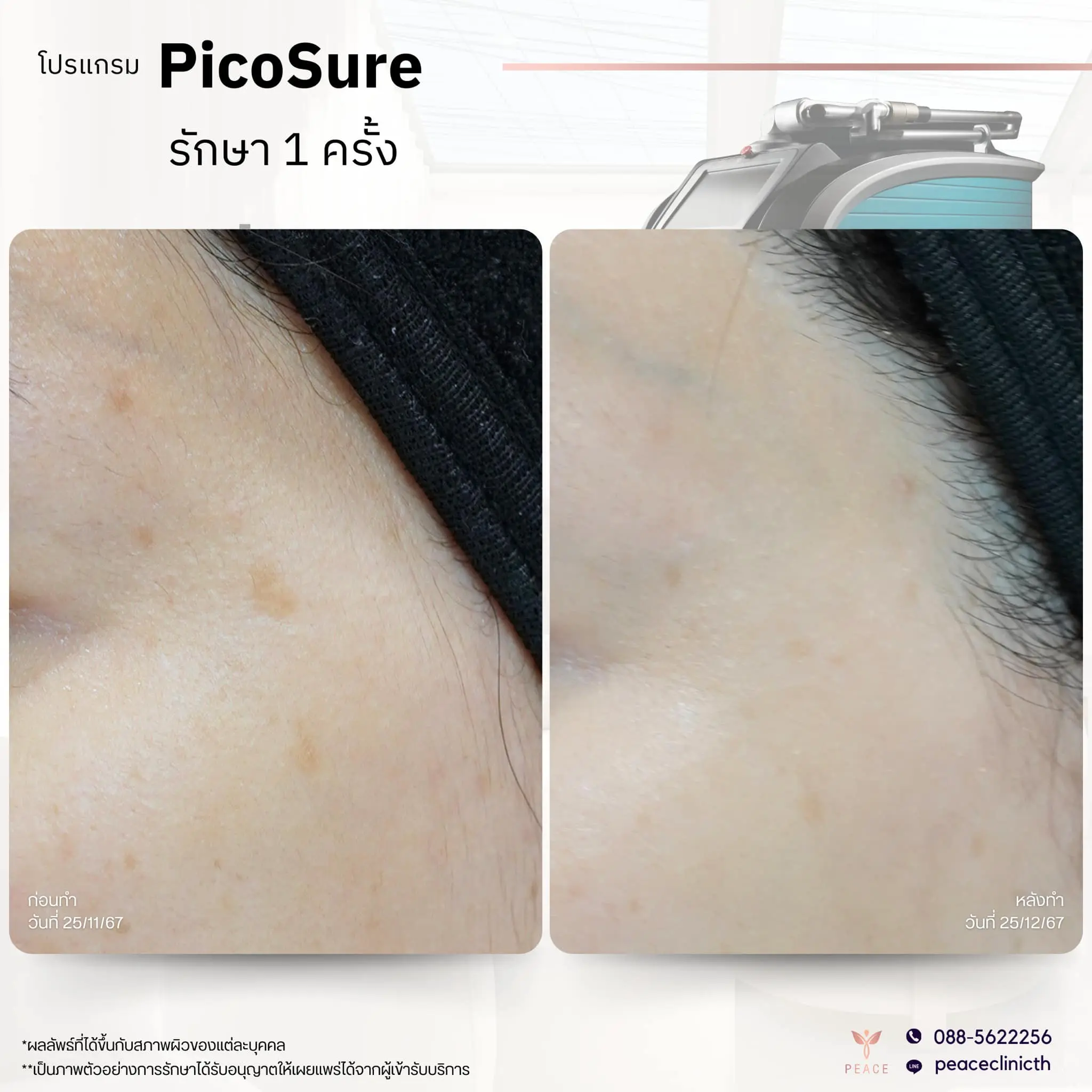 รีวิวผลลัพธ์ โปรแกรม PicoSure แม่สอด 4
