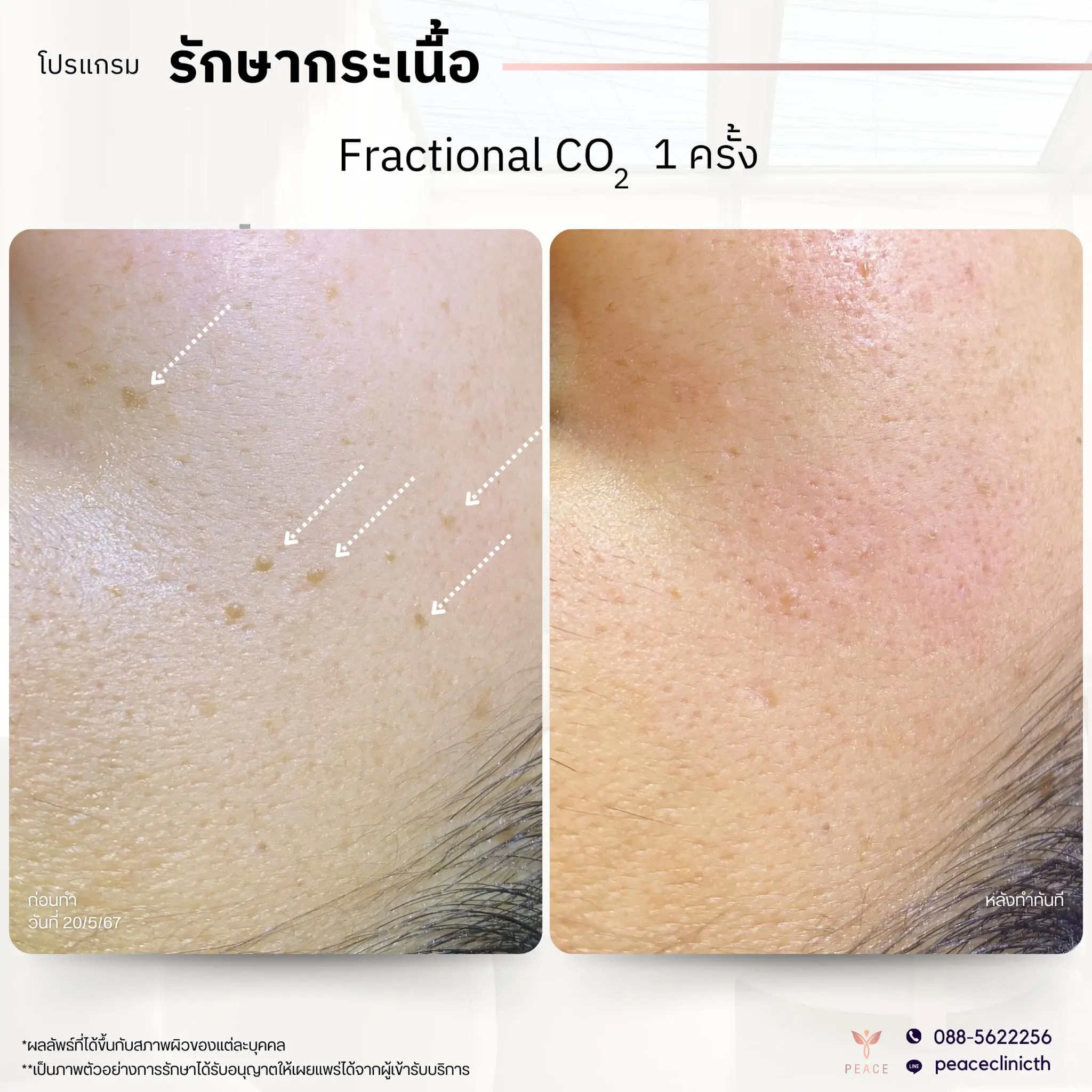 รีวิวผลลัพธ์ โปรแกรม PicoSure แม่สอด 5