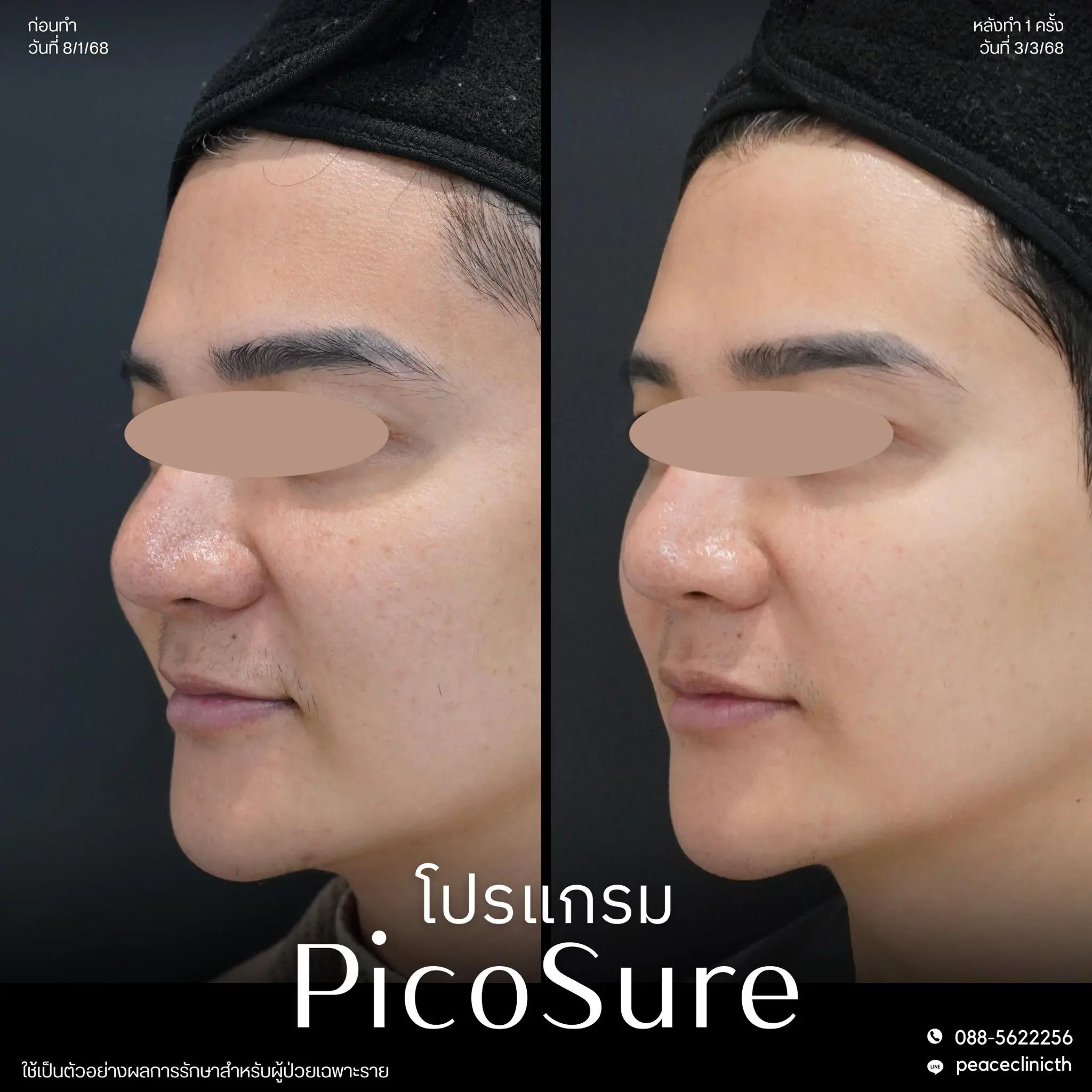 รีวิวผลลัพธ์ โปรแกรม PicoSure แม่สอด 6