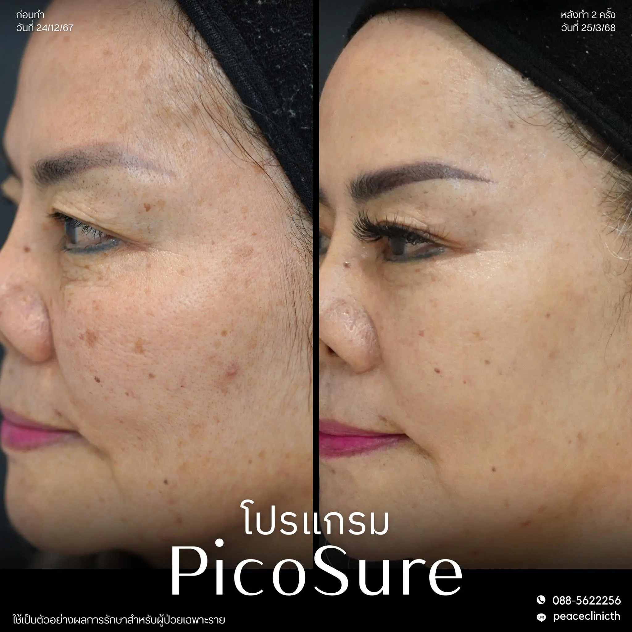 รีวิวผลลัพธ์ โปรแกรม PicoSure แม่สอด 7