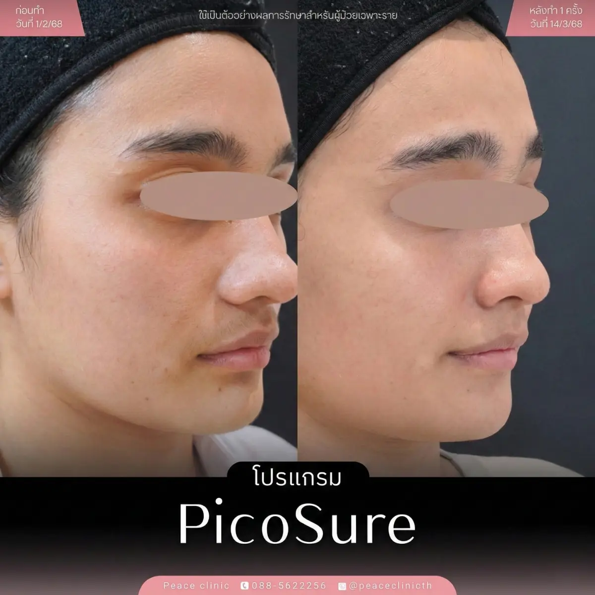 รีวิวผลลัพธ์ โปรแกรม PicoSure แม่สอด 8
